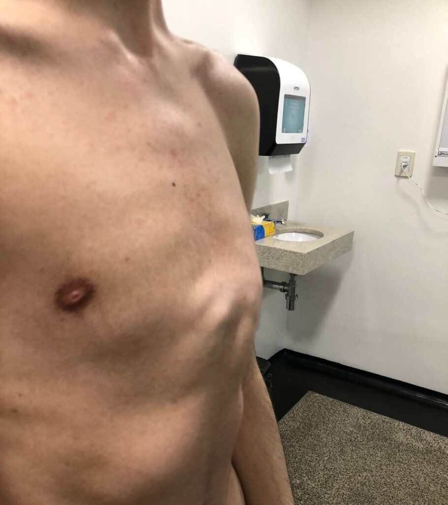 Paciente do HGG com peito de pombo